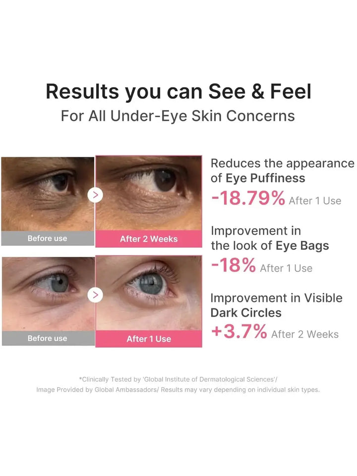 A clinical results chart showing before-and-after close-ups of eye puffiness and dark circle reduction using the Medicube PDRN Caffeine Collagen Eye Patch | Twentyseven