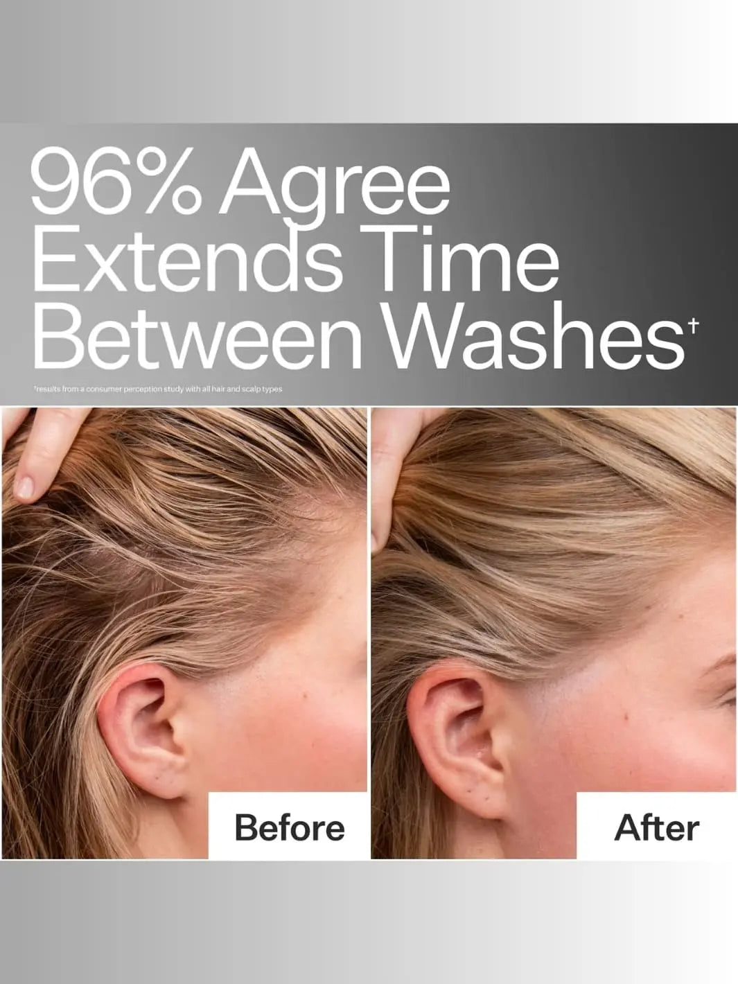 Before and after comparison of Act+Acre Oil Control Pro System on a person's scalp | Twentyseven Toronto