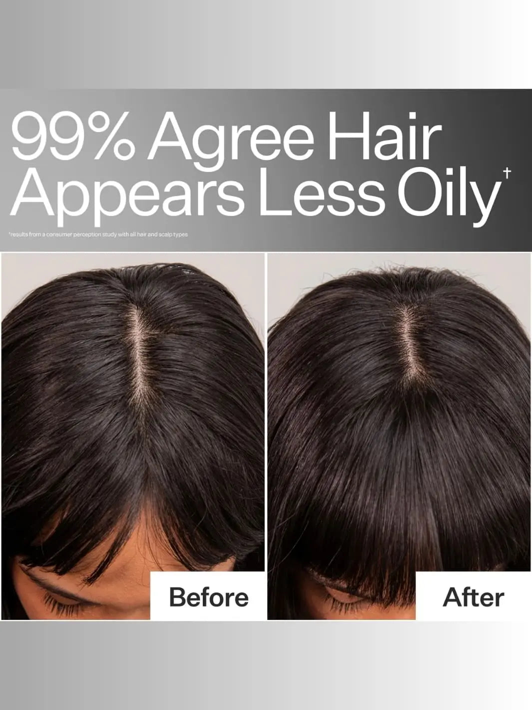 Before and after comparison of Act+Acre Oil Control Pro System on a person's scalp | Twentyseven Toronto