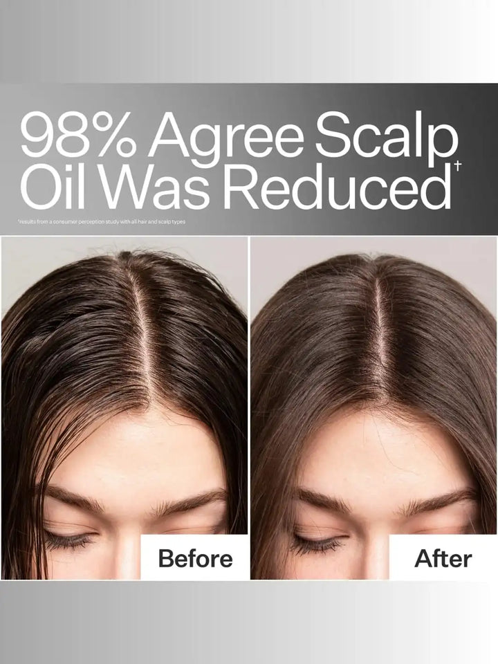 Before and after comparison of scalp oil reduction with text '98% Agree Scalp Oil Was Reduced' after using Act+Acre Oil Control Pro System | Twentyseven Toronto
