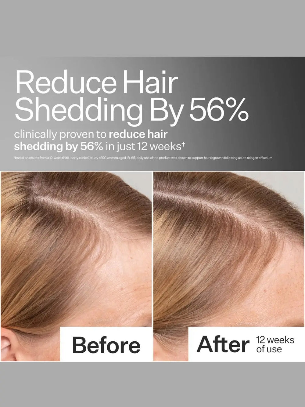Before and after comparison of hair shedding reduction using Act+Acre Cold Processed Apple Stem Cell Scalp Serum with text indicating 56% reduction clinically proven | Twentyseven Toronto