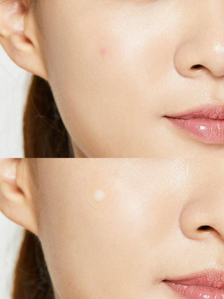COSRX Acne Pimple Master Hydrocolloid Pimple Patches | Twentyseven Toronto