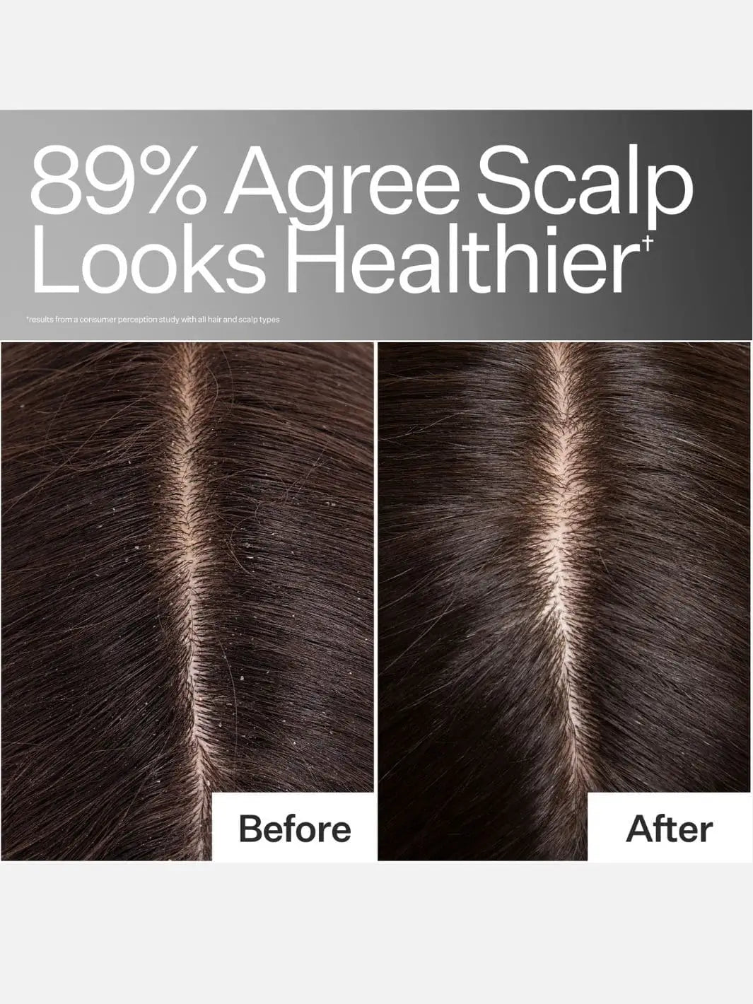 Before and after comparison of scalp health after using Act+Acre Cold Processed Hair Cleanse with text indicating improvement | Twentyseven Toronto