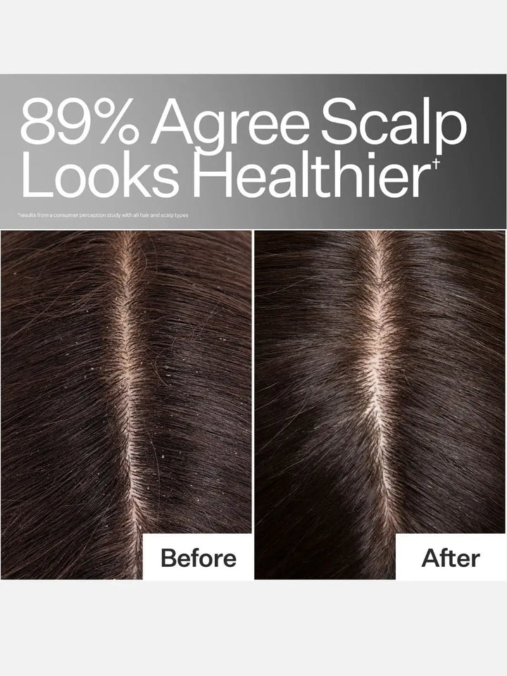 Before and after comparison of scalp health after using Act+Acre Cold Processed Hair Cleanse with text indicating improvement | Twentyseven Toronto