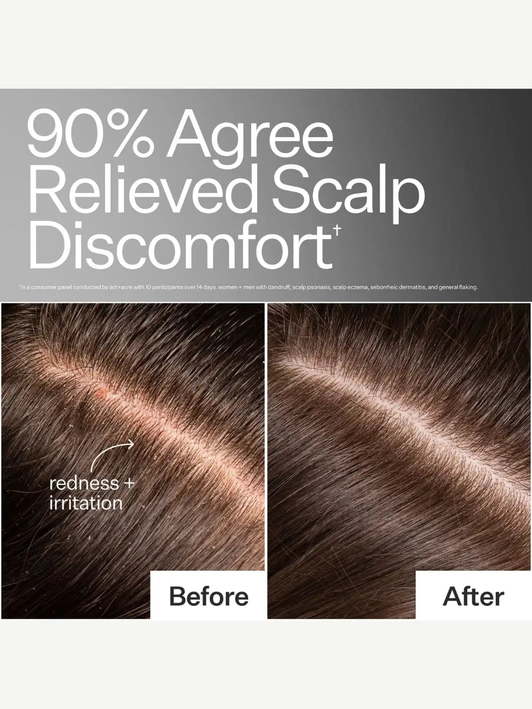 Before and after comparison of scalp with redness and irritation using Act+Acre Microbiome Cooling Scalp Serum, showing relief with text '90% Agree Relieved Scalp Discomfort' | Twentyseven Toronto