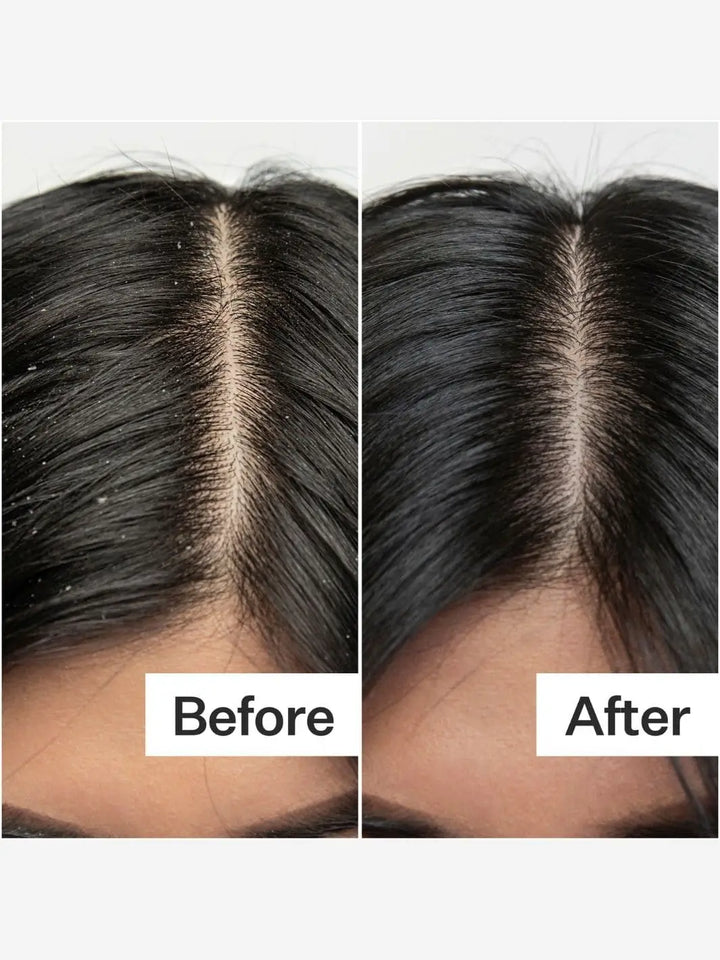 Before and after comparison of scalp health after using Act+Acre BHA Salicylic Acid Scalp Exfoliator Scalp Renew | Twentyseven Toronto