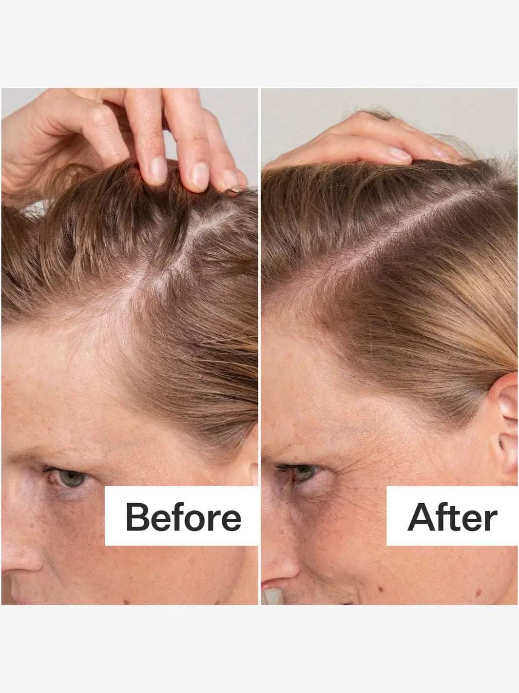 Before and after comparison of scalp health after using Act+Acre BHA Salicylic Acid Scalp Exfoliator Scalp Renew | Twentyseven Toronto