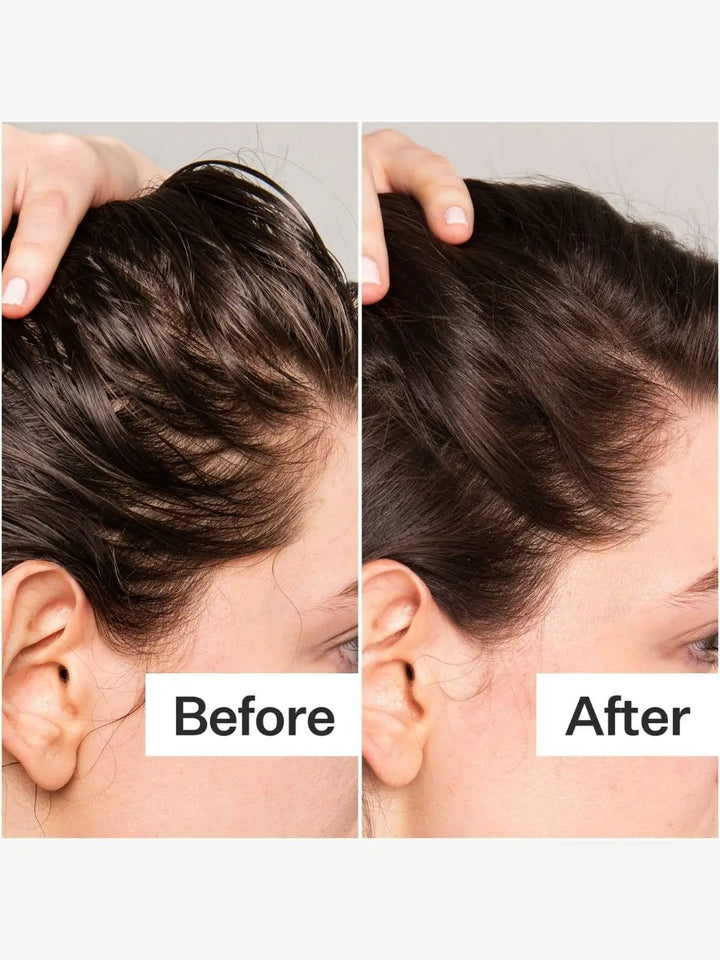 Before and after comparison of scalp health after using Act+Acre BHA Salicylic Acid Scalp Exfoliator Scalp Renew | Twentyseven Toronto