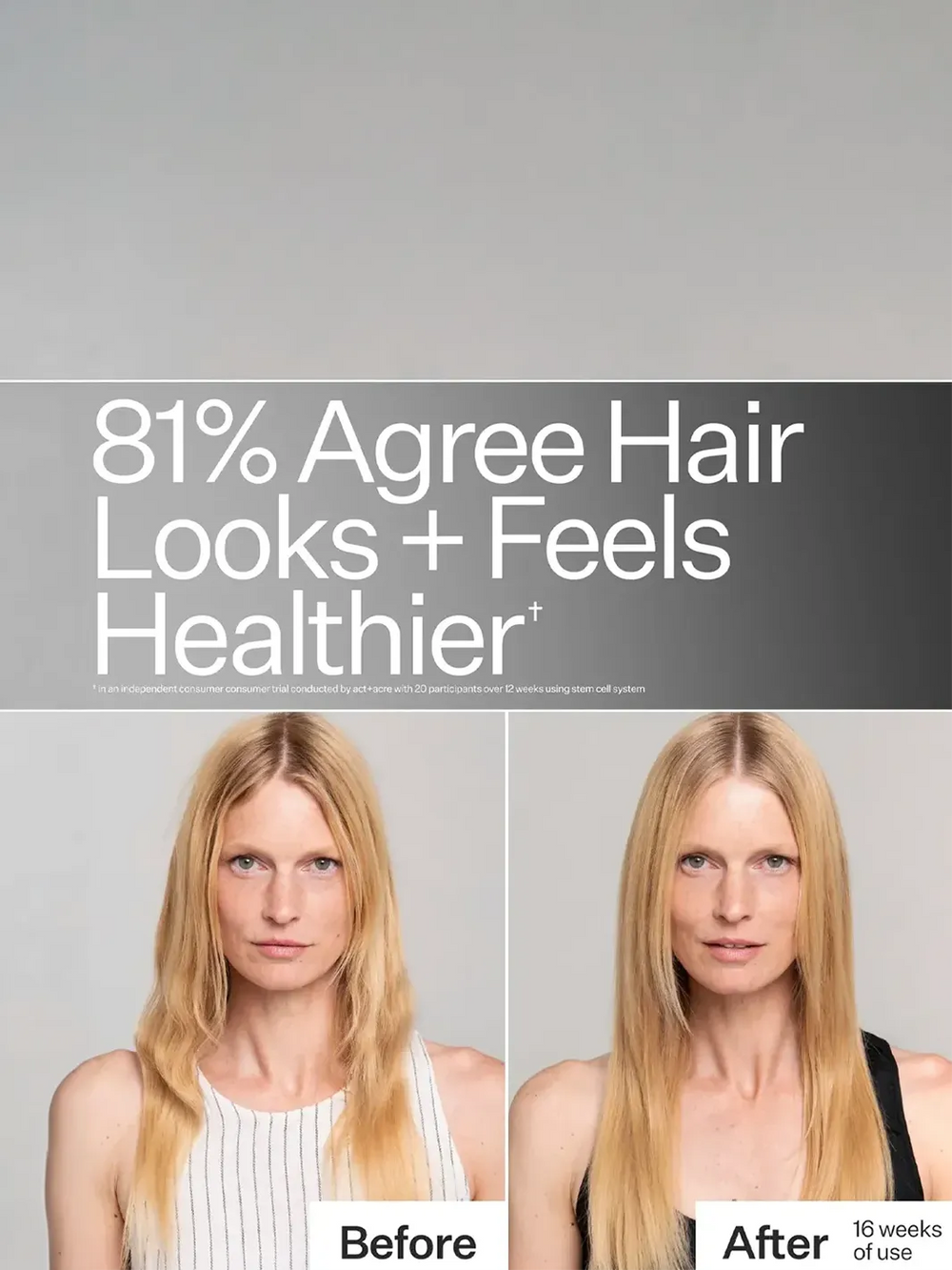 Act+Acre Stem Cell System before-and-after showing improved hair growth after 16 weeks of use | Twentyseven Toronto