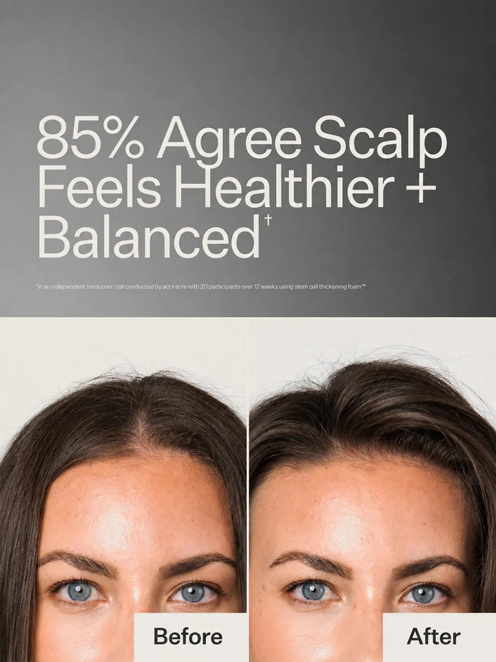Before and after results for Act+Acre Stem Cell Thickening Foam, with 85% agreeing their scalp felt healthier and more balanced after 12 weeks | Twentyseven Toronto