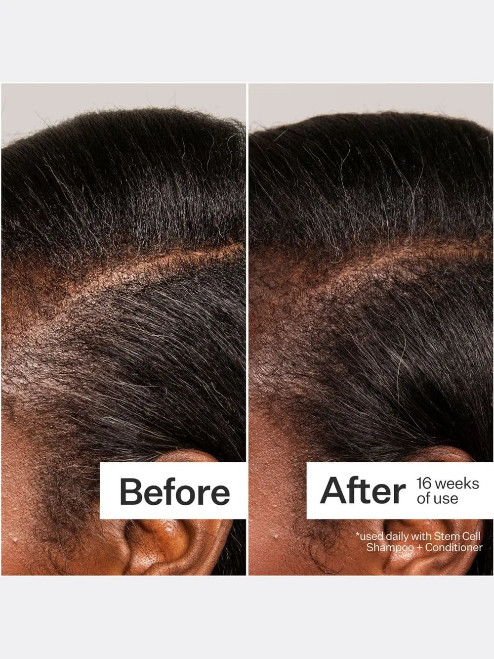 Before and after comparison of hair growth using Act+Acre Stem Cell Peptide Serum with text indicating usage duration | Twentyseven Toronto