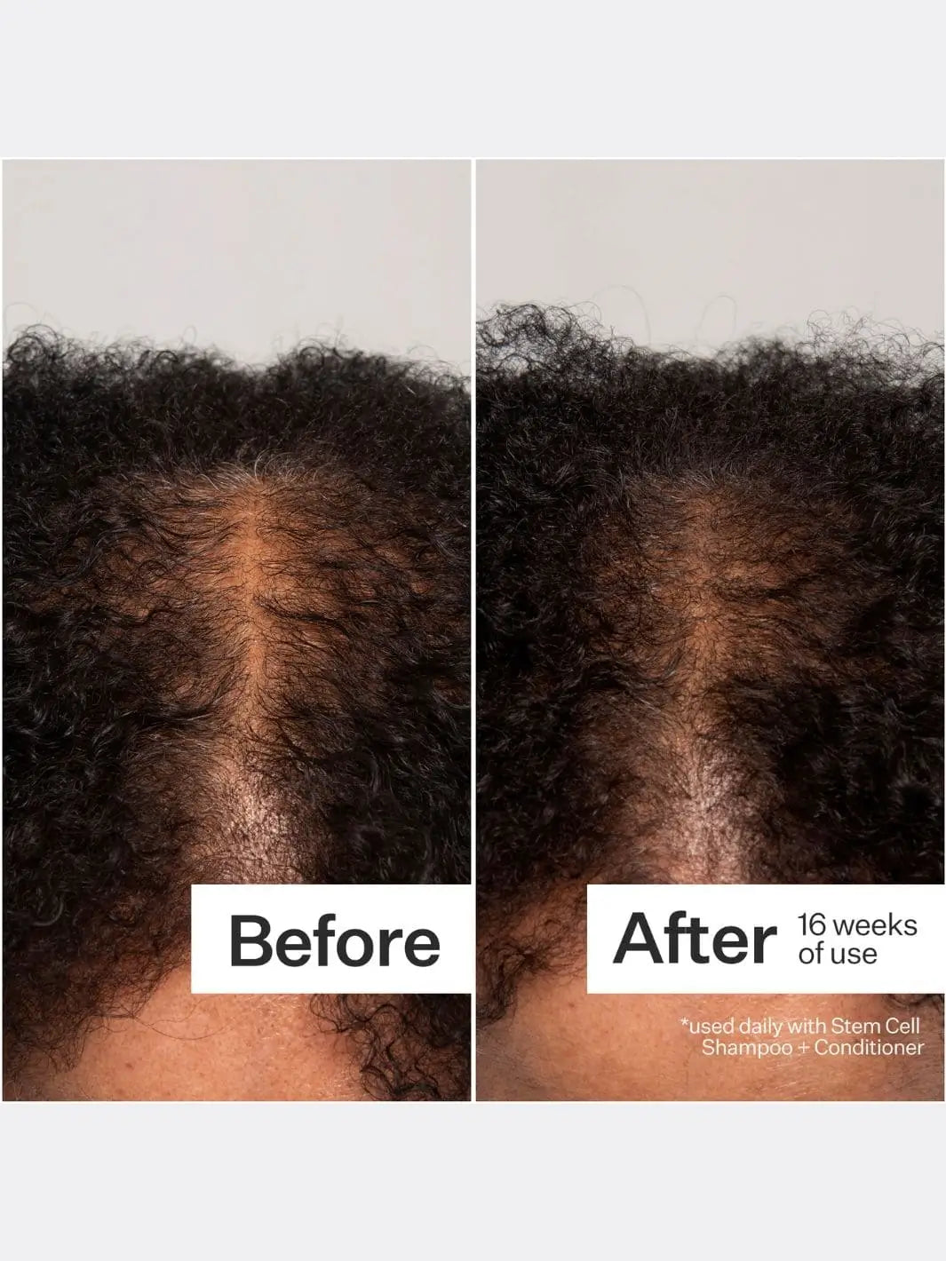 Before and after comparison of hair growth after using Act+Acre Stem Cell Peptide Serum with text indicating 16 weeks of use | Twentyseven Toronto