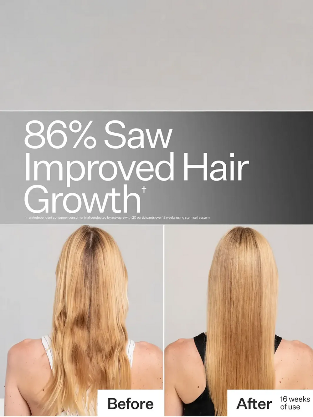 Act+Acre Stem Cell System before-and-after showing improved hair growth after 16 weeks of use | Twentyseven Toronto