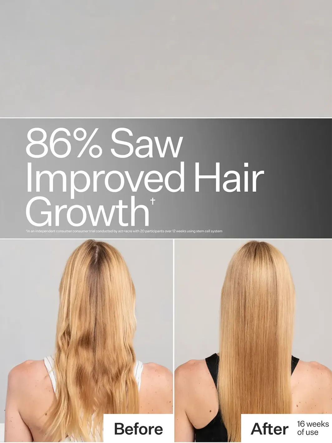 Act+Acre Stem Cell System before-and-after showing improved hair growth after 16 weeks of use | Twentyseven Toronto