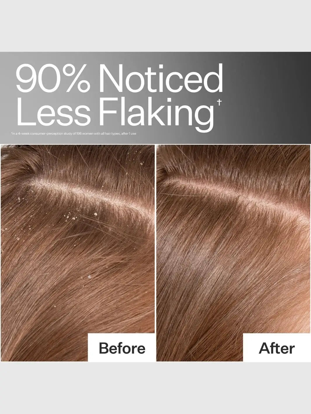 Before and after comparison of flaky scalp after using Act+Acre Vitamin E Scalp Detox with text indicating 90% less flaking | Twentyseven Toronto