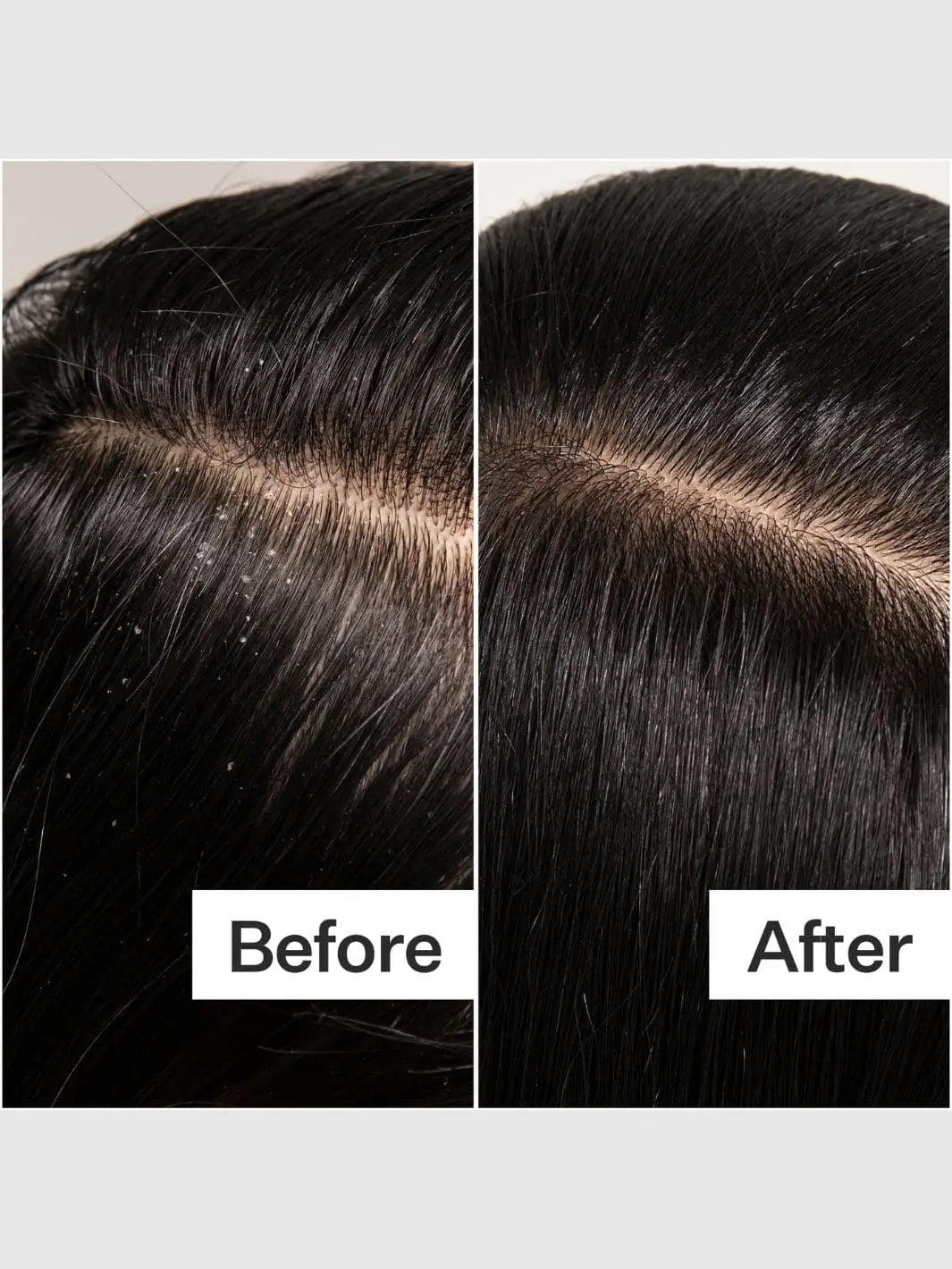 Before and after scalp comparison with use of Act+Acre Vitamin E Scalp Detox Oil | Twentyseven Toronto